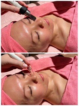 なちゅら(Nachula)の写真/夏のお肌の黒ずみ・皮脂・角栓・角質ケアは、リピート率・満足度当店NO1の毛穴洗浄で徹底美肌ケア!