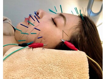 セルフィット鍼灸整骨院の写真/【効果をしっかり実感できる美容鍼】実績豊富な施術者が担当☆小顔×美肌が叶う◎初めての方もオススメ！