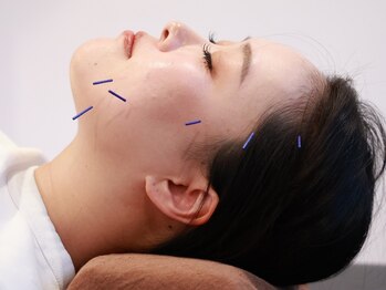 コハルはり灸整骨院(koharuはり灸整骨院)の写真/【初回限定◆美容鍼＋首肩こり集中マッサージ￥3980】針が初めてでもリラックスして受けられると人気です◎