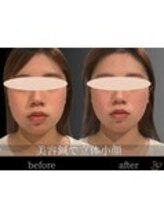 チョコバリ 錦糸町店(chocobari)/小顔×リフトアップ(美容鍼)20代