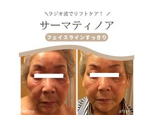 クリニカルエステ リフィーナ 西荻窪店の雰囲気（強力引締めのサーマティノアでダウンタイムなくピンッ！とリフト）