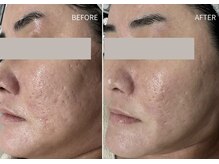 ENA/ララピール施術例