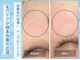 ブルーム(Bloom)の写真/美白ケアで感動体験！繰り返すニキビも根本からケアし、透明感あふれる素肌へ導きます♪