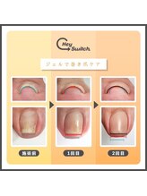 シュガーファイブ ネイル(Sugar5 nail)/ジェルネイルで巻き爪ケア