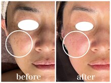 ルー ハナレ 神戸岡本 摂津本山店(Luu HANARE)/シミ改善 くすみ透明感