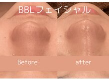 エピーレ(EPiRe:)の雰囲気（毛穴の引き締り、リフトアップ、透明感の効果◎口コミ10％オフ）
