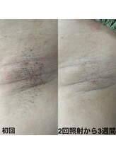 トリップ(trip)/ワキ脱毛