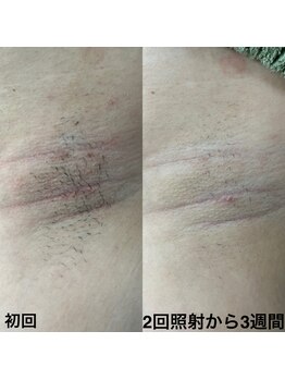 トリップ(trip)/ワキ脱毛