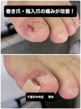 巻き爪じゅん 千葉駅前店/巻き爪・陥入爪の痛みを改善！
