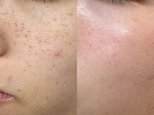 プレナ(PLENA)/生まれつきのそば〇すも改善！