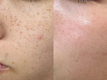 プレナ(PLENA)/生まれつきのそば〇すも改善!