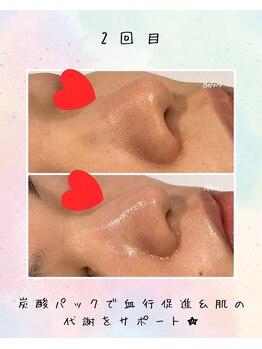 リリアン(lirien)/毛穴/毛穴ケア/毛穴洗浄/駒込