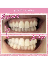 エクシアホワイトフジ(ecxia white fuji)/ホワイトニングビフォーアフター