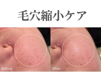 エトレ(etre)/毛穴/黒ずみ/カーボキシー/小顔