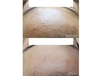 モニ 福岡(Moni)/ハーブピーリング で ニキビケア