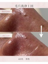 ル シャ/メンズ脱毛/毛穴洗浄/ヘッドスパ