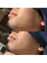 カナウ(KANAU)/ヒゲ脱毛（20代前半男性）