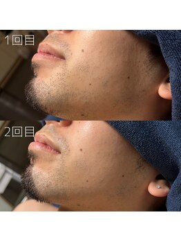 カナウ(KANAU)/ヒゲ脱毛（20代前半男性）