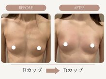 ウェルバスト(Well Bust)/【バストアップ例】B→Dカップ