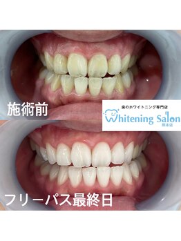 ホワイトニングサロン 熊本店/熊本セルフホワイトニング