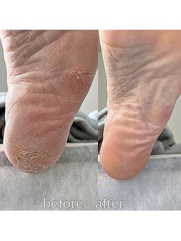 フットミー(foot mii)/