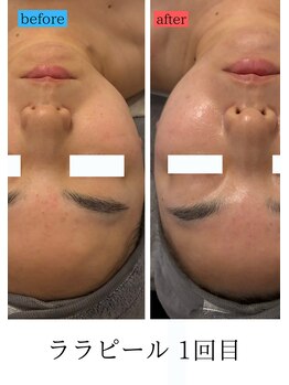 ユフラ(Juhla)/ララピール