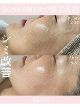 ミロン(miron)/シミ改善