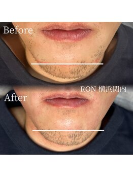 サロンロン 横浜関内(SALON RON)/髭/美容電気脱毛