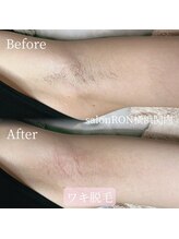 サロンロン 横浜関内(SALON RON)/脇の脱毛/美容電気脱毛