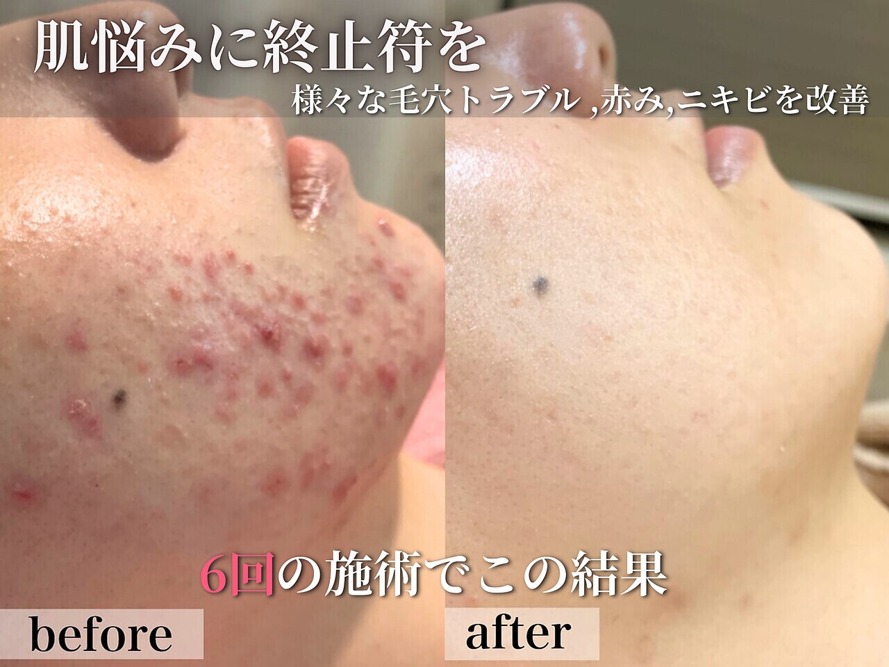 肌質改善エステサロン♡ エステサロン ジョアアンジェ(joie ange)｜ホットペッパービューティー