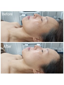 レン(Ren)/ラテスパ〈毛穴洗浄/美白/ツヤ〉