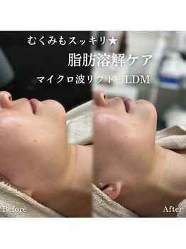 イロハ(IROHA)/施術前後◎