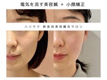 ハリサクの雰囲気(継続ケアで小顔に♪)