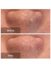 ハニー(Honey)/鼻の黒ずみ気になる方