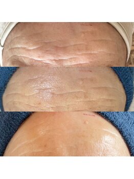 ジョンミー(JONMEE)/ピーリングでおでこのしわ改善◎