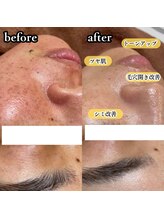 ニューズビューティー(neu's beauty)/【剥離あり】ハーブピーリング♪