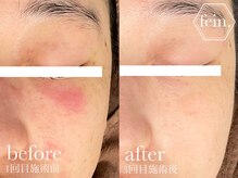 フェイン 青山店(fein.)/赤み・ニキビにアプローチ＾＾