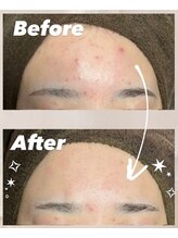 ガーオガーオ 新宿 四ツ谷(GaaoGaao)/ハーブピーリング/2回目