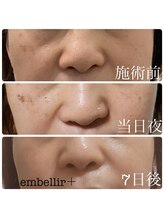 アンベリールプラス(embellir+)/光フォトで毛穴レス☆