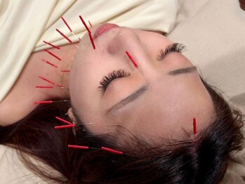 りずむの写真/【実力派女性鍼灸師対応】内側から変える究極エイジングケア!オ-ダ-メイド美容鍼で小顔&ハリ艶溢れる美肌へ
