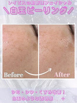レイビス 盛岡店(RAYVIS)/ピーリングで根本改善
