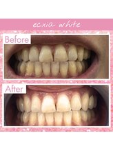 エクシアホワイトフジ(ecxia white fuji)/ホワイトニングビフォーアフター