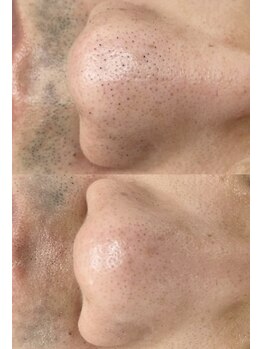 カルディエ(Cardie)/肌質改善　ビフォーアフター