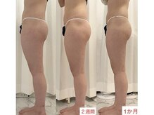 美人バスト 静岡店/痩身症例