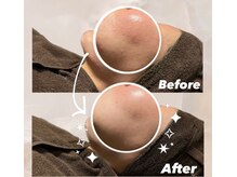 ガーオガーオ 新宿 四ツ谷(GaaoGaao)/ハーブピーリング/3回目