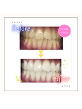 エクシアホワイトニング 麻布十番店/【Ecxiaホワイトニング】症例