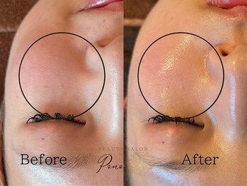 ポノ(Pono)/毛穴ケアでうる艶お肌へ★