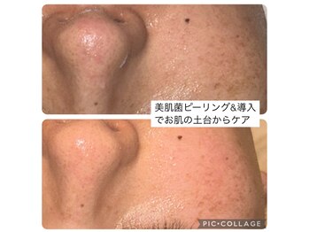 リ シェリール(Re cherir)/美肌菌ピーリングで毛穴ケア