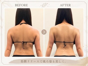 ほねつぎ長嶺鍼灸接骨院の写真/ブライダル筋膜リリース×姿勢改善♪猫背・巻き肩をケアしてドレス映えを目指す