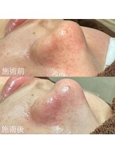 エクラ バイ シャンリィ(eclat by shanLy)/肌質改善！